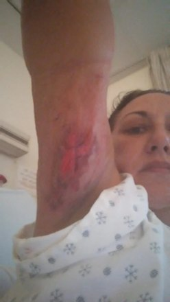 Mulher Corta A Mao Com Papelao E Quase Morre Por Infeccao