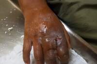 A água fervente queimou o dorso da mão e abriu feridas nos dedos do menino