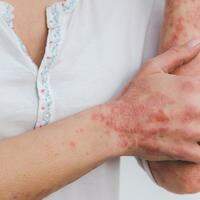 Imagem Ilustrativa: na fase adulta, as dermatites podem ser visíveis e afetar a autoestima das pessoas