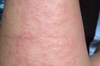 Alterações na pele semelhantes com ressecamento e alergia podem significar infecção pela Ômicron