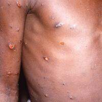 O sintoma mais característico da doença consiste em lesões na pele