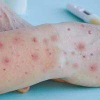 Erupções na pele são um dos sintomas da varíola dos macacos, outra ameaça global