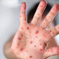 Pará tem 13 casos confirmados de Monkeypox.