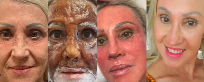 Peeling De Fenol Antes E Depois O Que E Qual O Valor Em 2023 Sa de peeling-de-fenol-antes-e-depois-o-que-e-qual-o-valor-em-2023-sa-de