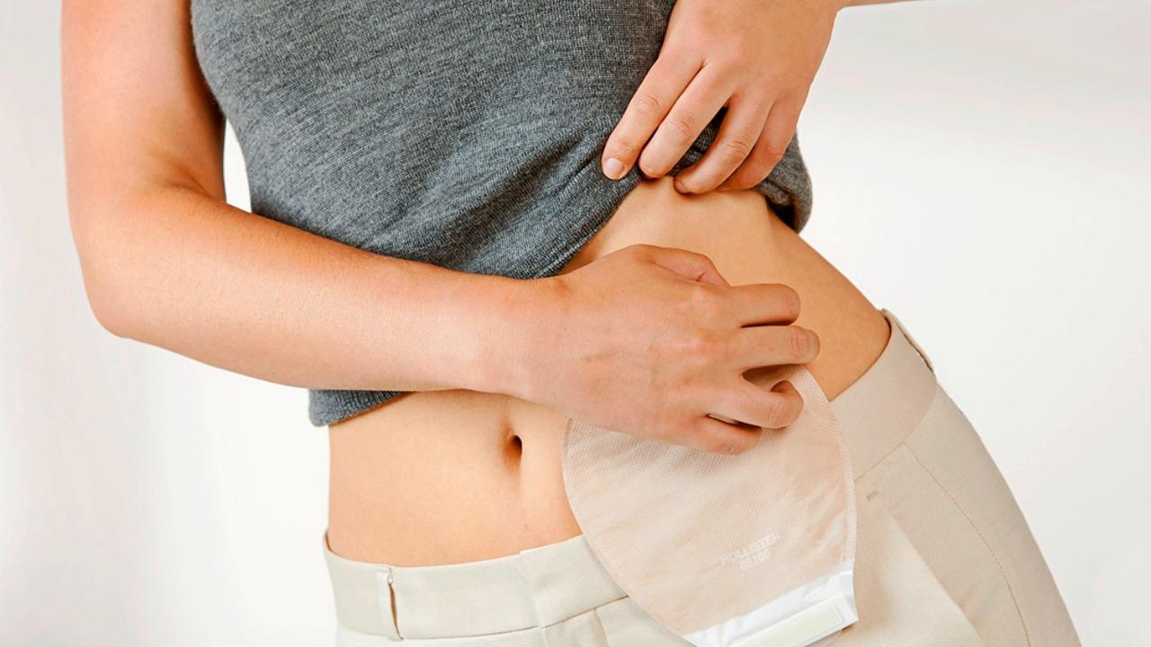 Dia Nacional da Pessoa Ostomizada: campanha prev&ecirc; combate ao preconceito |  Par&aacute; | O Liberal