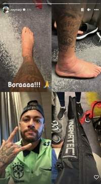Tornozelo do Neymar durante tratamento