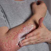 A psoríase é uma doença caracterizada pela presença de manchas avermelhadas na pele