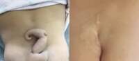 Antes e depois da menina que nasceu com cauda