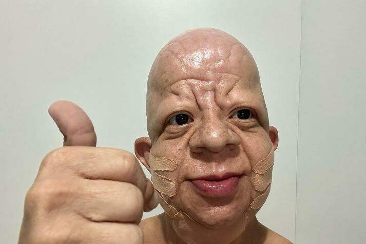 Bruno Diferente faz harmonização facial e compartilha resultado na