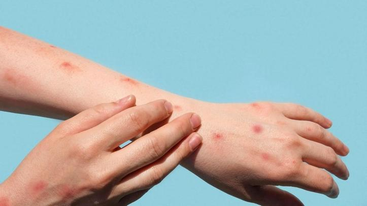 Região Norte registra 52 casos confirmados de mpox em 2025
