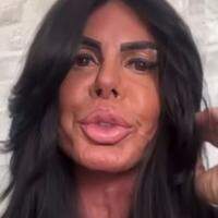 Gretchen aparece sem filtro nas redes e detalha nova fase de procedimentos estéticos.
