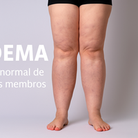 Lipedema